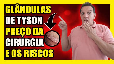 Glândulas de Tyson: descubra o que são e sai... 